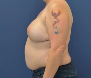 DIEP-Flap-Case--28021 | After DIEP Flap 2