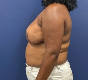 Breast-Reduction-Case--28242 | After Breast Reduction 2