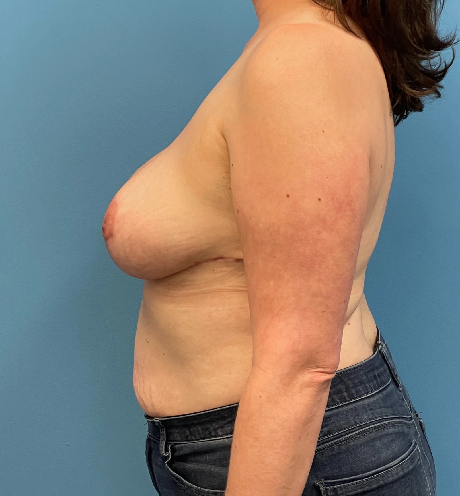 Breast-Reduction-Case--27625 | After Breast Reduction 2