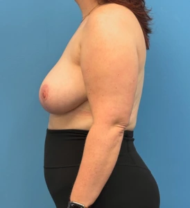 Breast-Reduction-Case--28338 | After Dr. Samir Rao 2