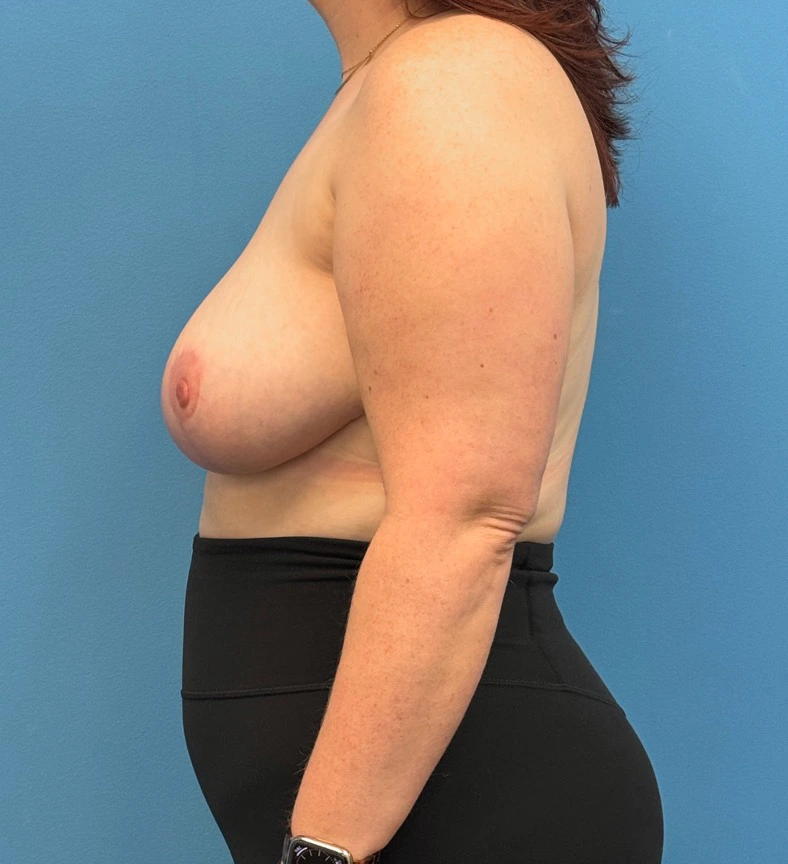 Breast-Reduction-Case--28338 | After Breast Reduction 2