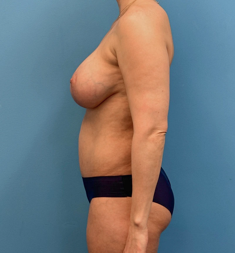 Breast-Augmentation-Tummy-Tuck-Case--28080 | After Body Lift 6