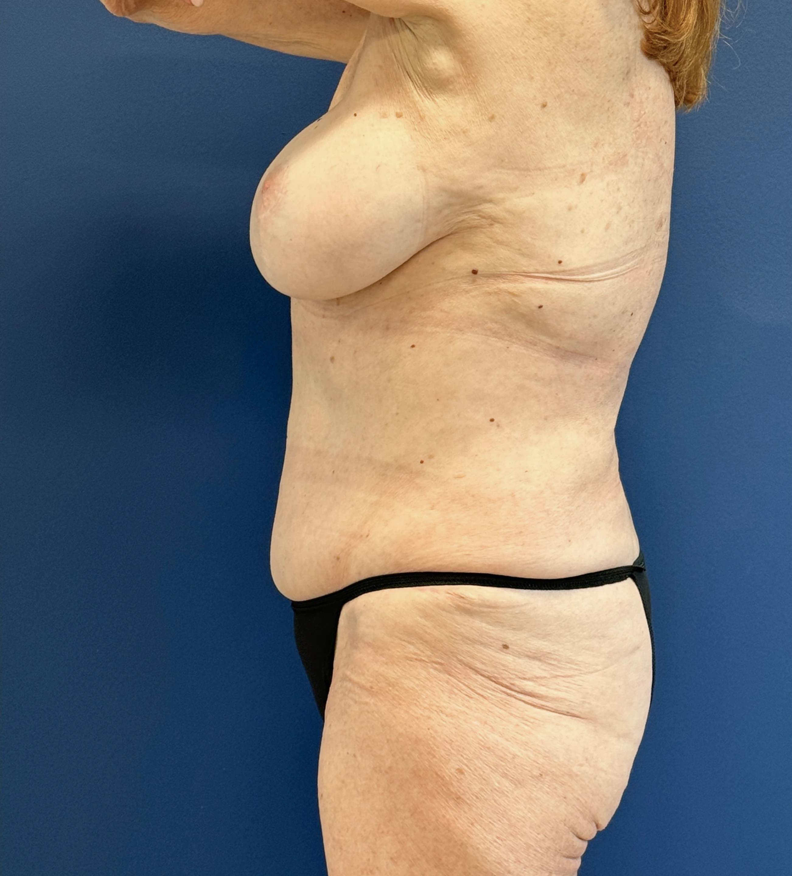 Lipoabdominoplasty-Case--27935 | After Liposuction 3
