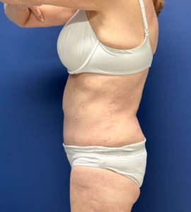 Abdominoplasty-Case--23690 | After Liposuction 2