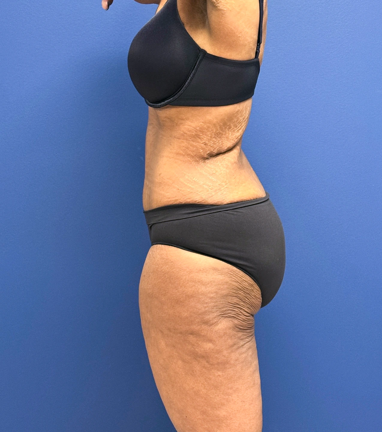 Tummy-Tuck-Case--28714 | After Tummy Tuck 3