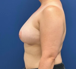 Breast-Reconstruction-Case--28689 | After Breast Reconstruction 2