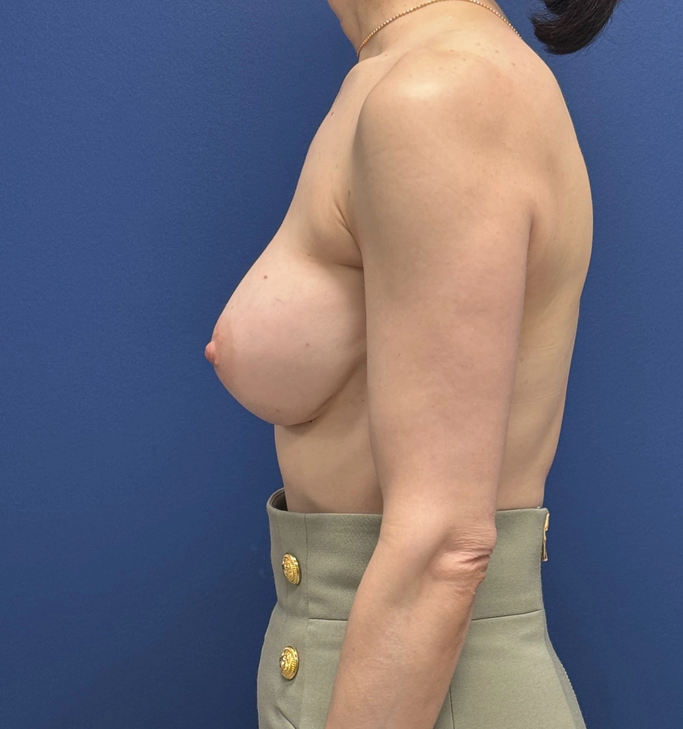 Revision-Augmentation-Case--26939 | After Revision Augmentation 3