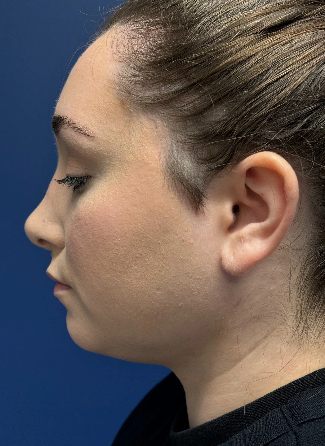 Submental-Liposuction-Case--29107 | After Submental Liposuction 3