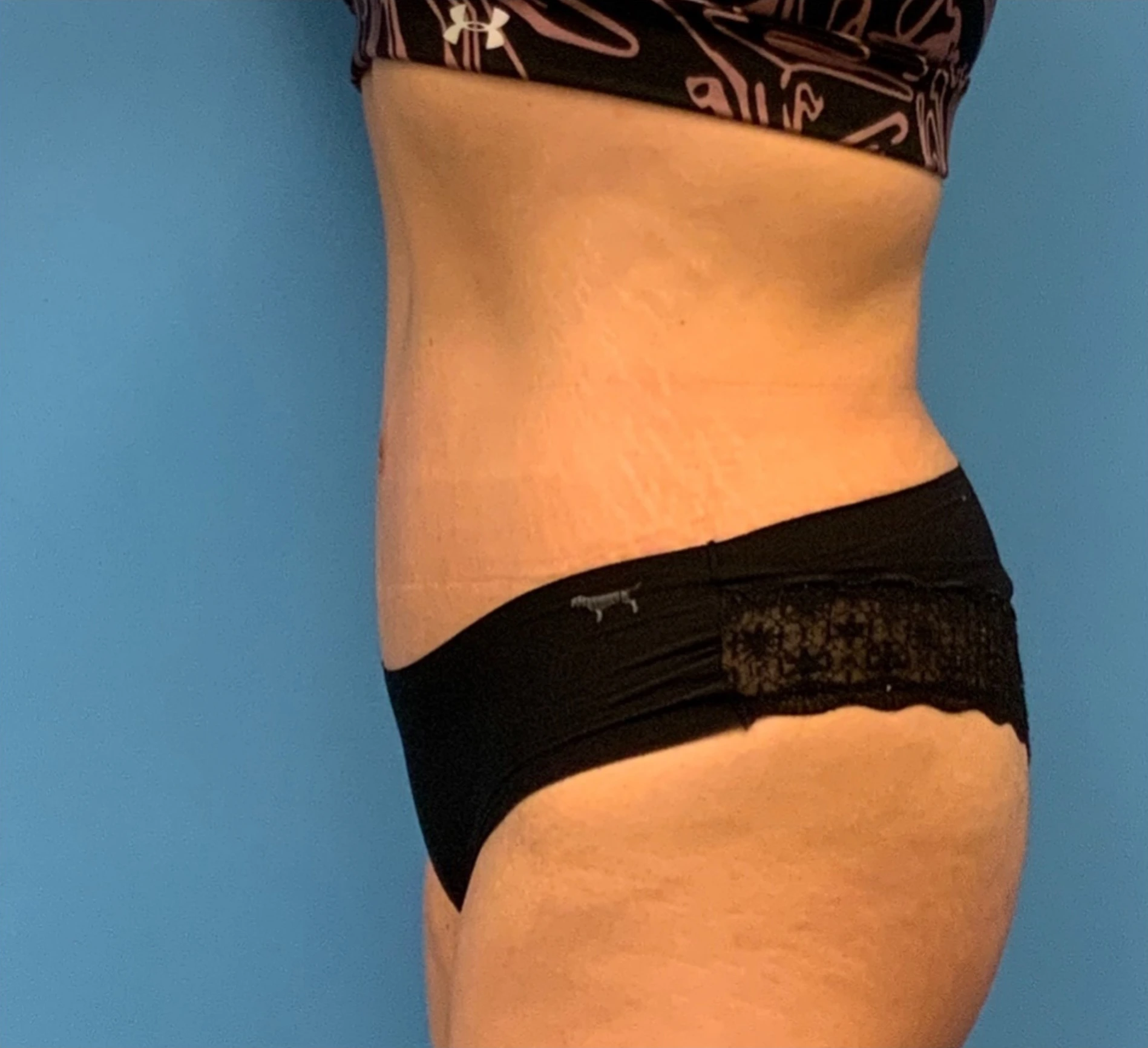 Abdominoplasty-Case--23747 | After Tummy Tuck 3