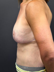 Augmentation-Mastopexy-Case--3055 | After Breast Augmentation With Lift 2