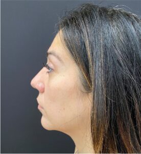 Rhinoplasty-Case--377 | After Rhinoplasty 2