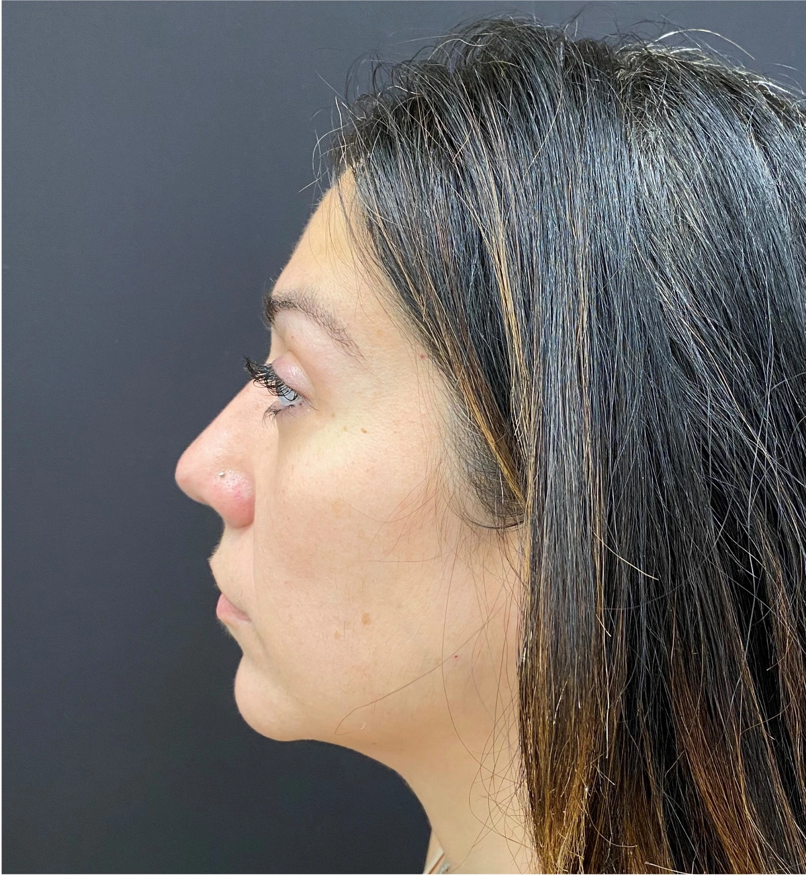 Rhinoplasty-Case--377 | After Rhinoplasty 2