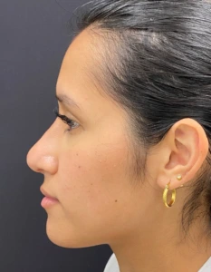 Rhinoplasty-Case--376 | After Rhinoplasty 2