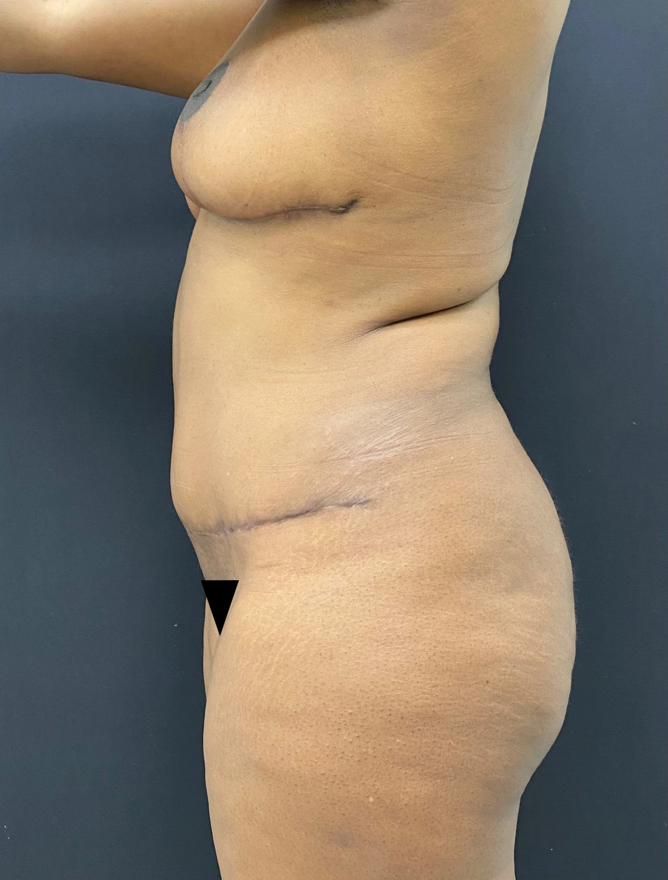 Mommy-makeover-Case--336 | After Mommy Makeover 2