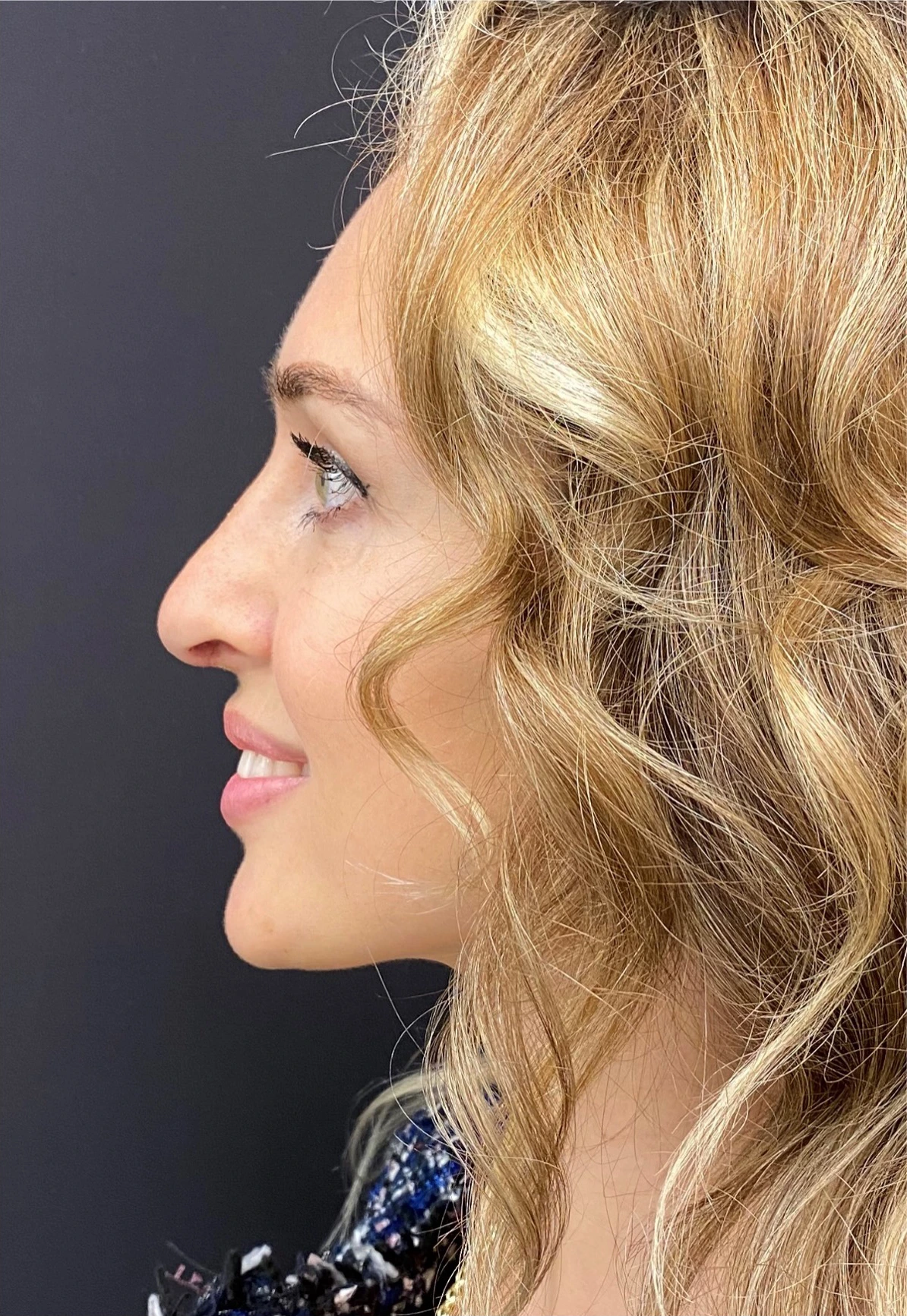 Rhinoplasty-Case--378 | After Rhinoplasty 2