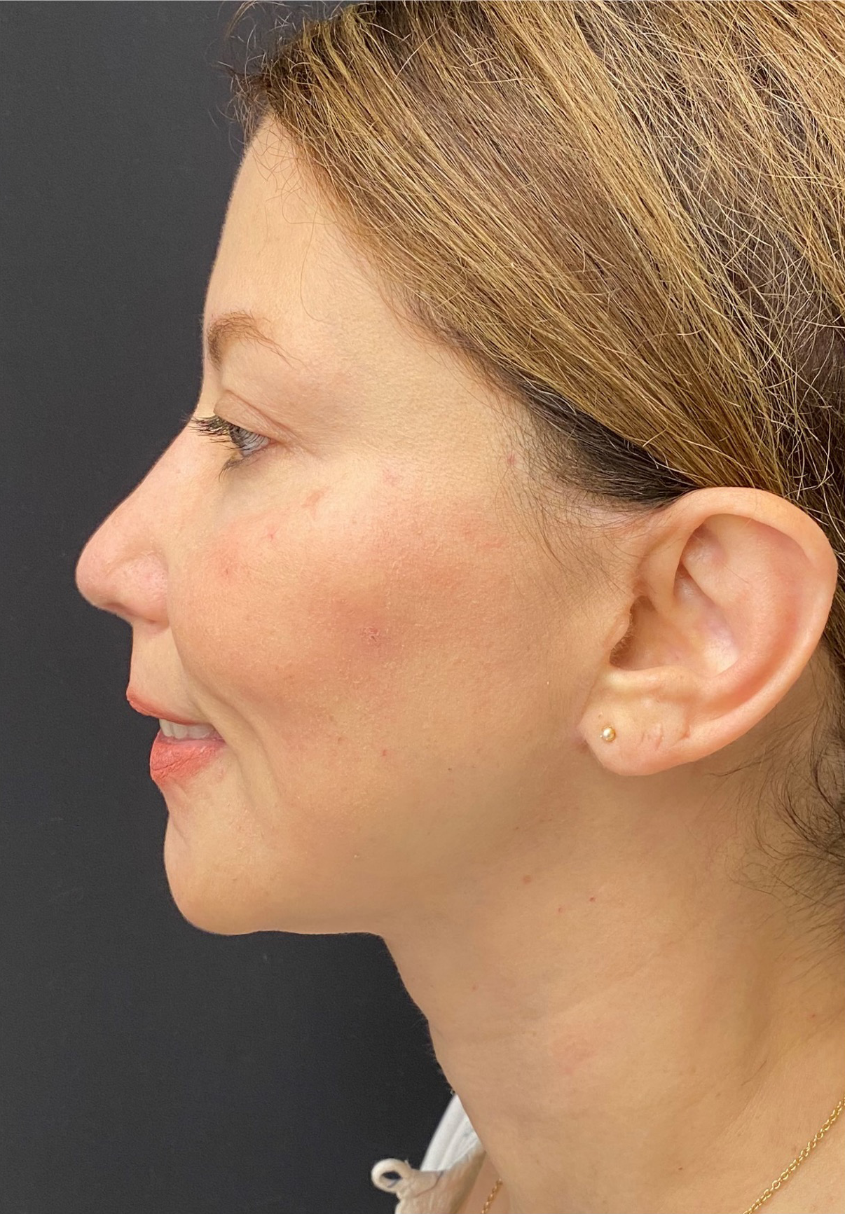 Rhinoplasty-Case--375 | After Rhinoplasty 1