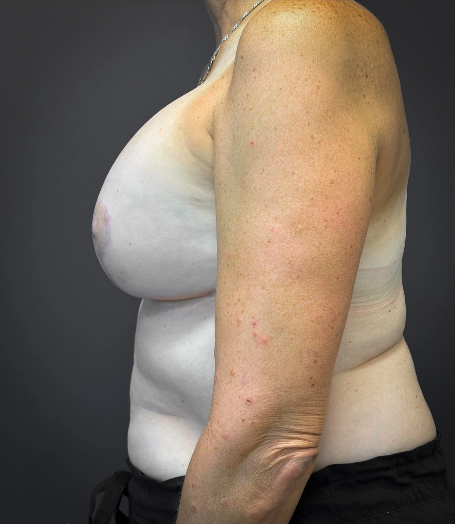 Augmentation-Mastopexy-Case--1213 | After Breast Augmentation With Lift 4