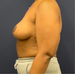 Breast-Reduction-Case--5320 | After Dr. Arjun Kanuri 2