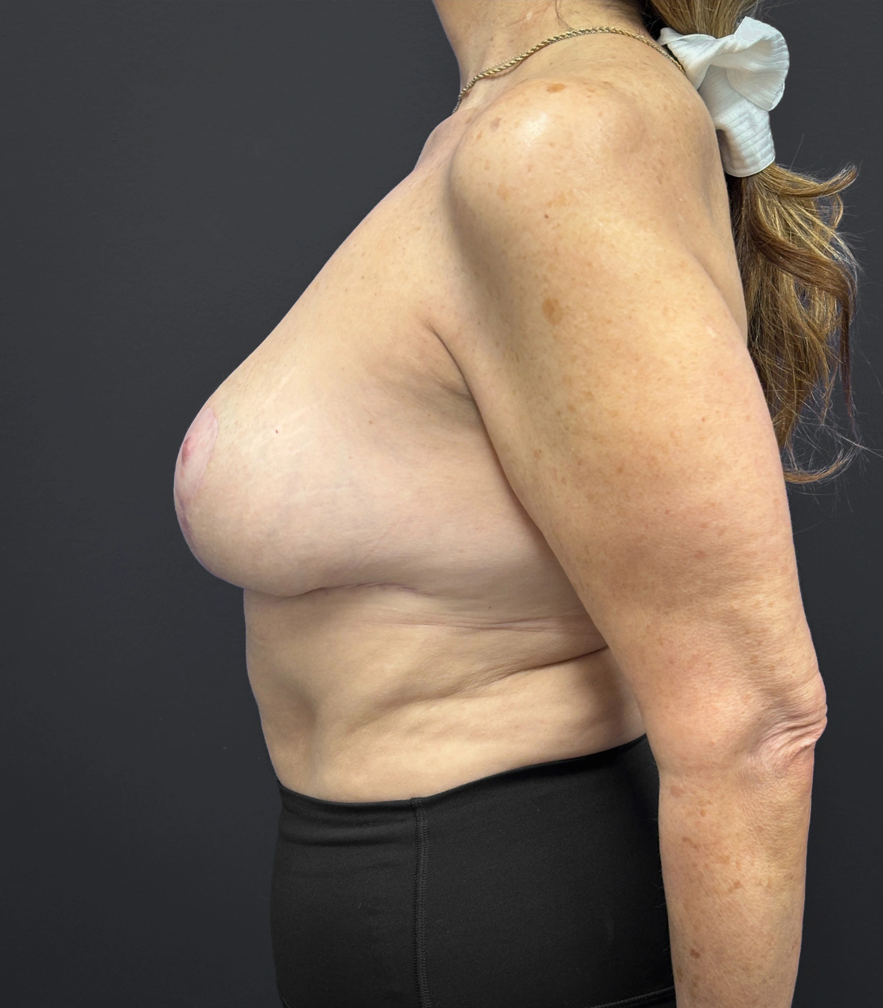 Breast-Reduction-Case--2538 | After Breast Reduction 2