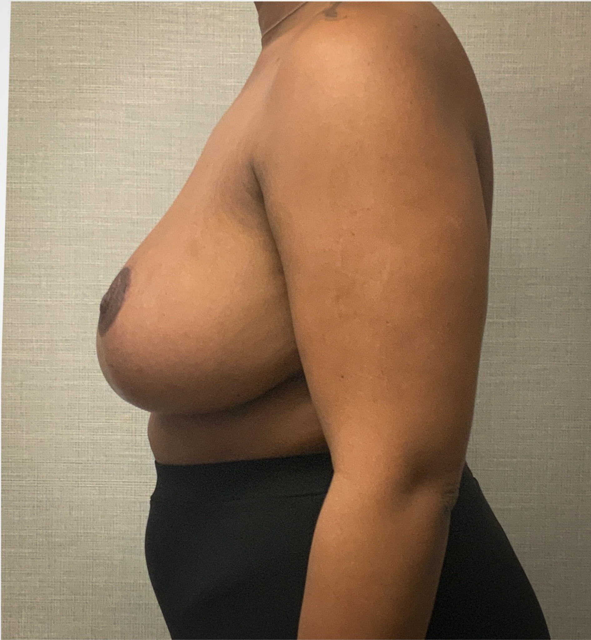 Breast-Reduction-Case--2564 | After Breast Reduction 2