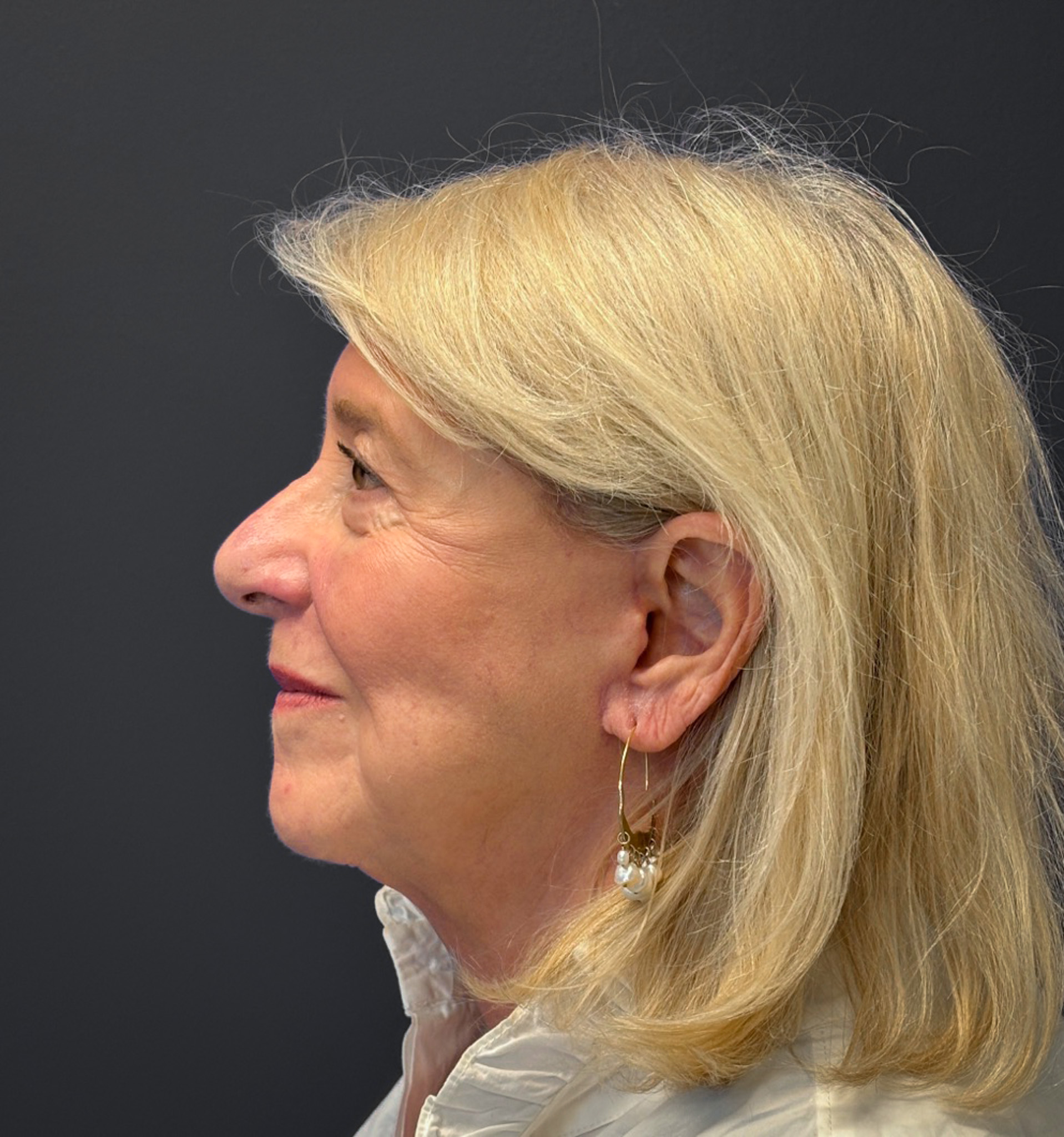 Blepharoplasty-Case--3336 | After Eyelid Surgery 6