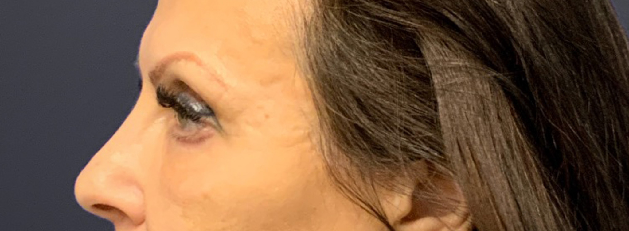 Blepharoplasty-Case--6272 | After Eyelid Surgery 5