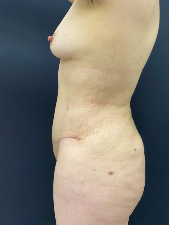 Lipoabdominoplasty-Case--339 | After Liposuction 3