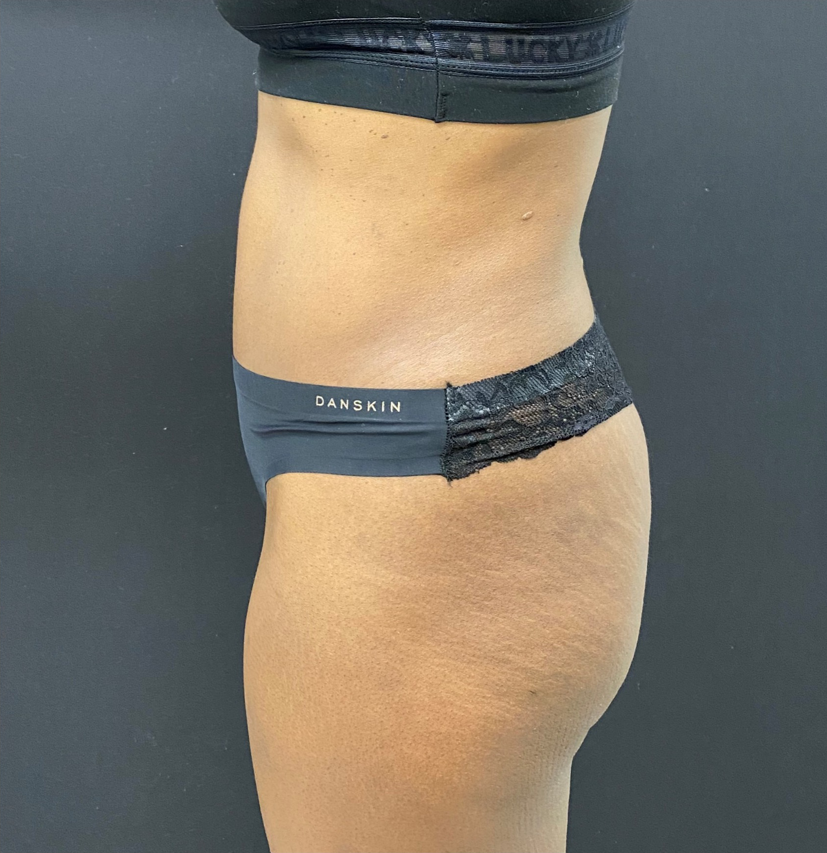 Abdominoplasty-Case--340 | After Tummy Tuck 3