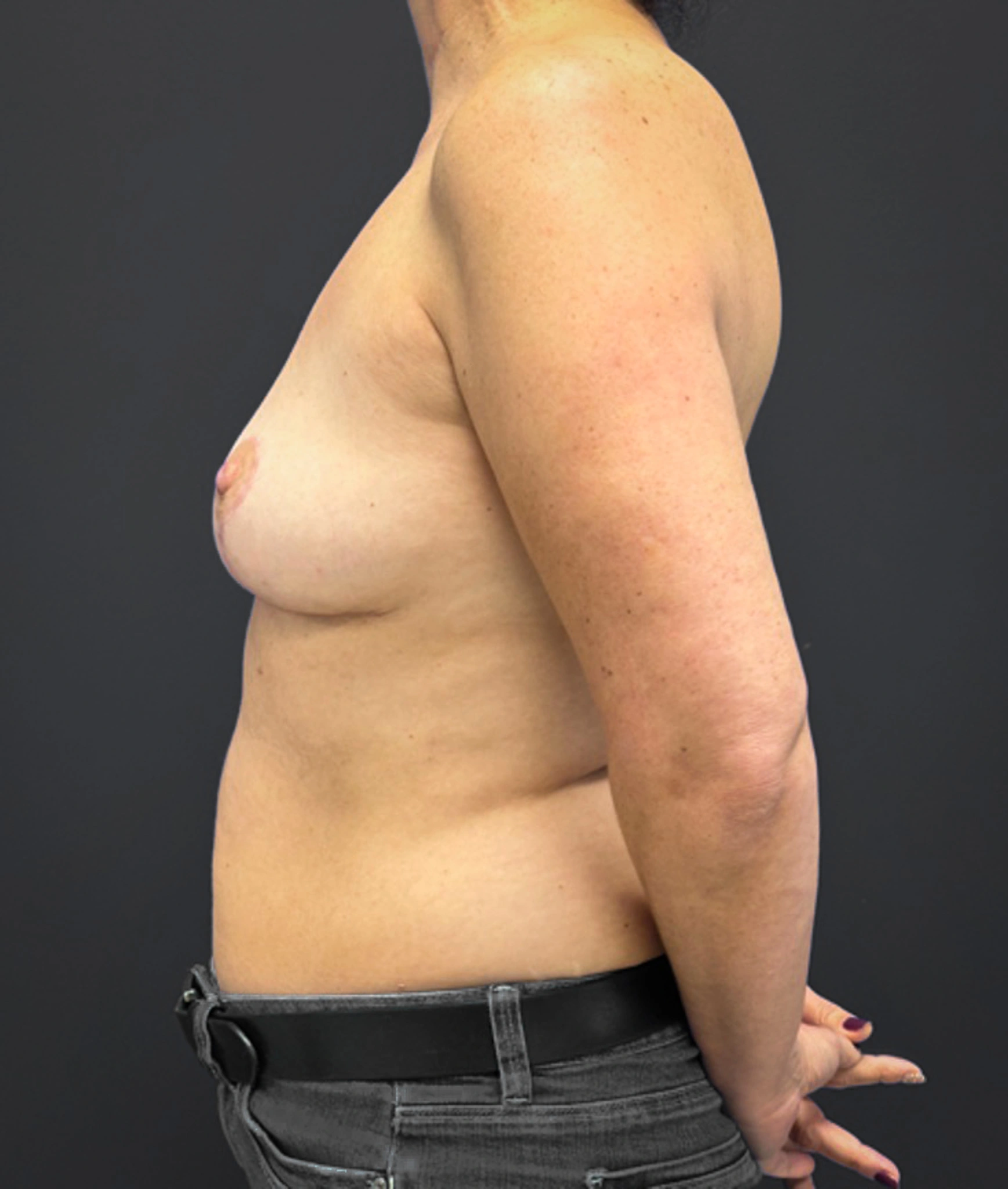 Mastopexy-Case--1663 | After Breast Lift 2