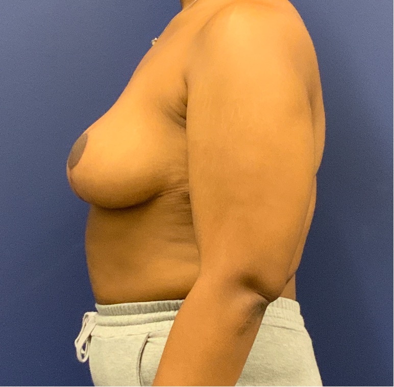 Breast-Reduction-Case--27281 | After Breast Reduction 3