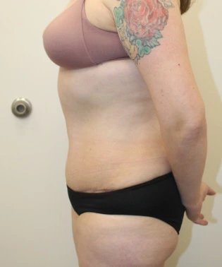 Liposuction-Tummy-Tuck-Case--343 | After Liposuction 3