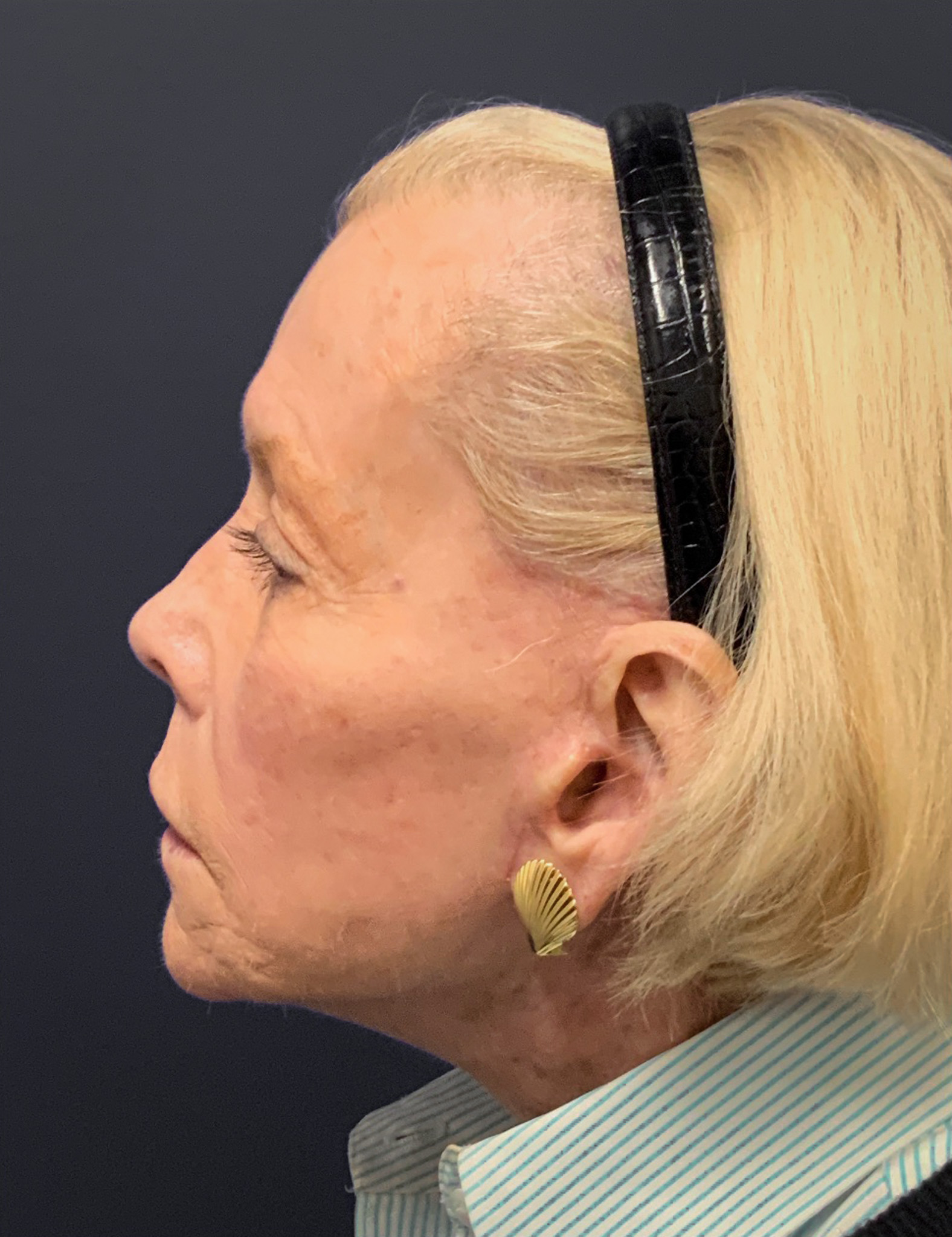 Facelift-Case--7247 | After Facelift 3