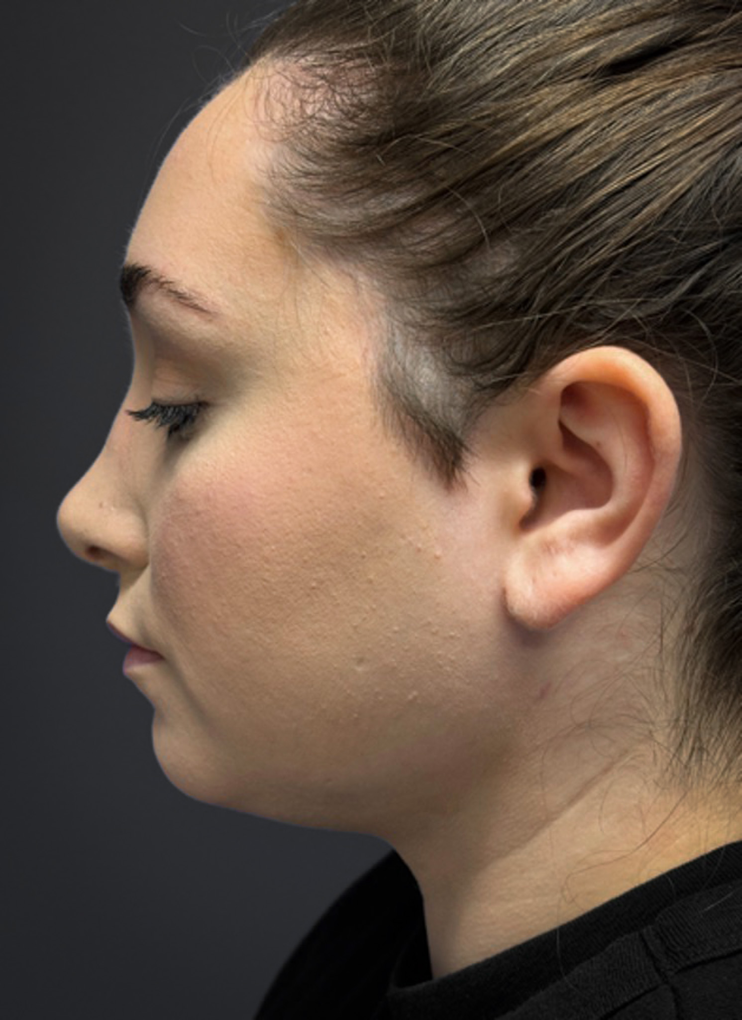 Submental-Liposuction-Case--3439 | After Submental Liposuction 3