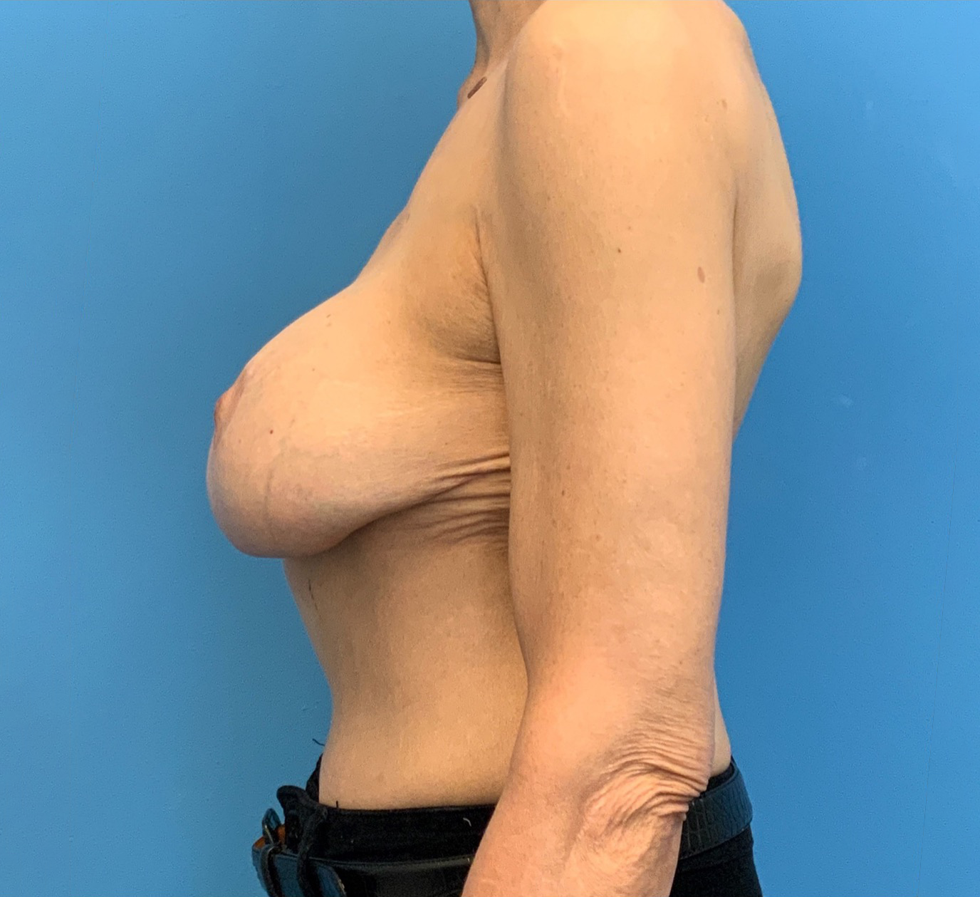 Breast-Augmentation-Mastopexy-Case--24958 | After Revision Augmentation 4