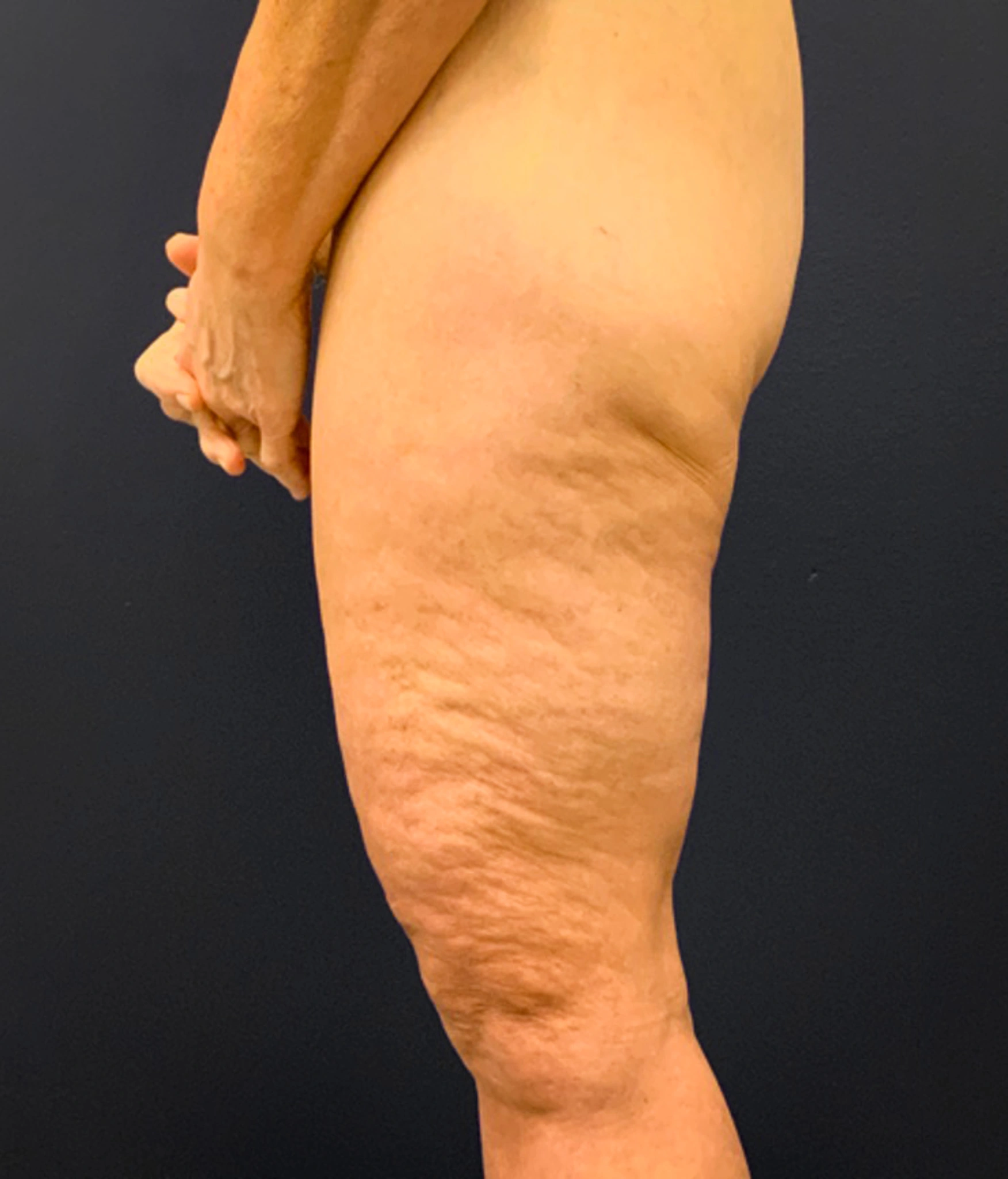 Thighplasty-Case--2024 | After Thigh Lift 3