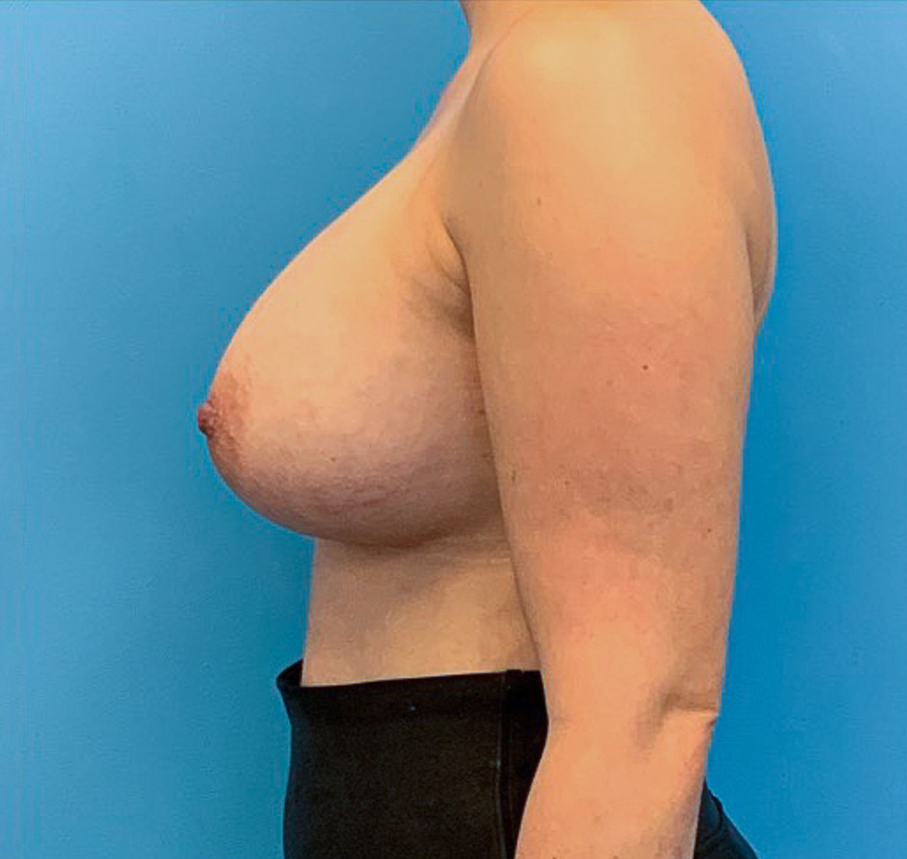 Breast-Augmentation-Case--23631 | After Breast Augmentation 4