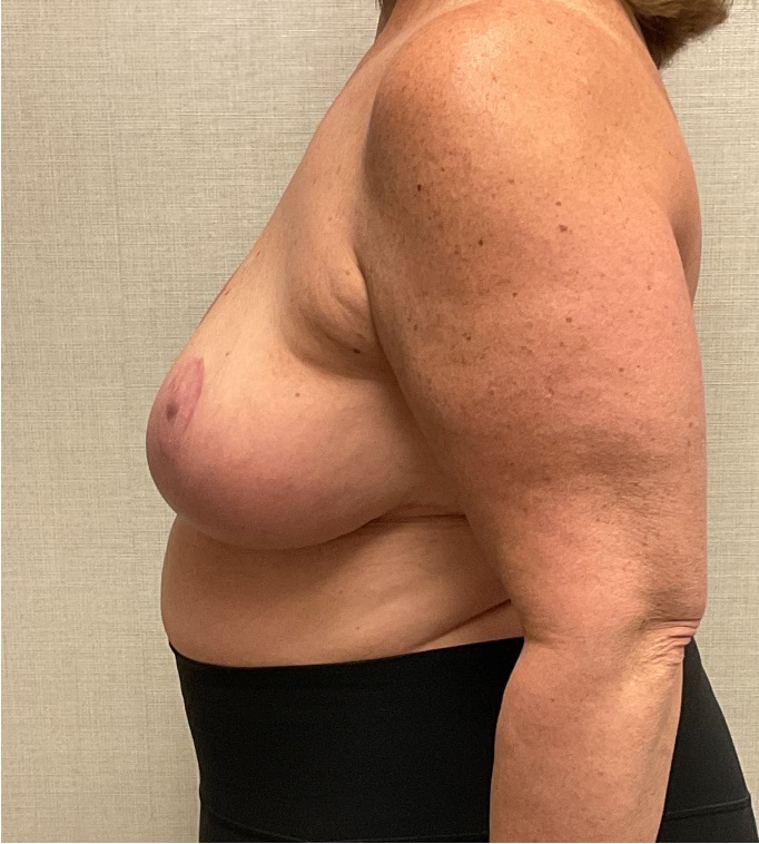 Breast-Reduction-Case--26425 | After Breast Reduction 2