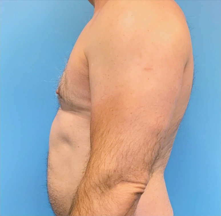 Gynecomastia-Case--20376 | After Gynecomastia / Male Breast Reduction 3