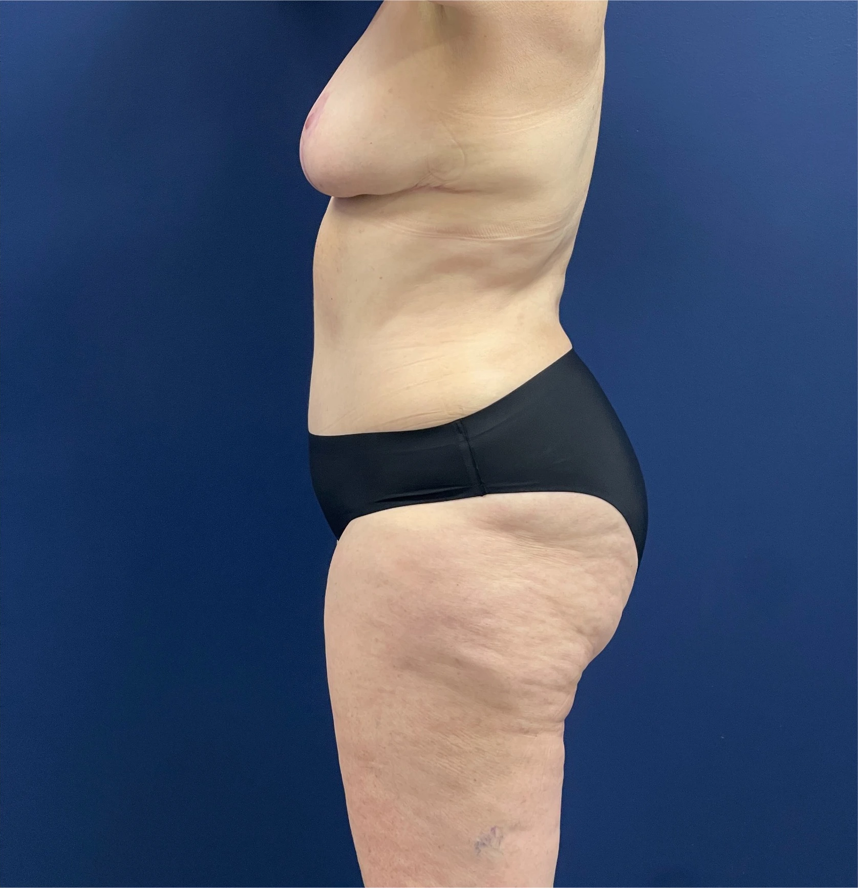 Mommy-Makeover-Case--26853 | After Mommy Makeover 2