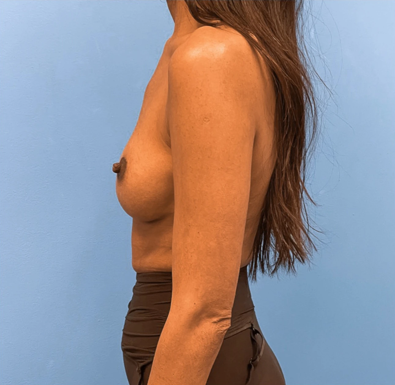 Breast-Augmentation-Case--25592 | After Breast Augmentation 2