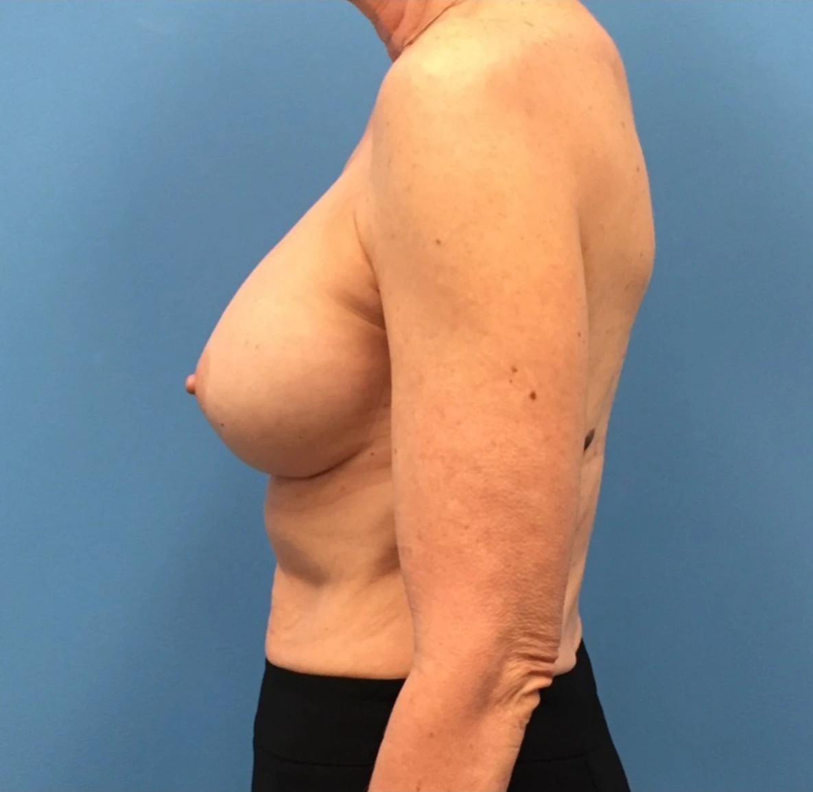 Revision-Breast-Augmentation-Case--237 | After Revision Augmentation 2