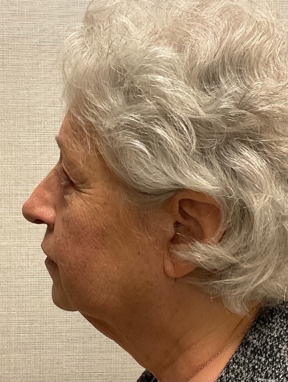 Rhinoplasty-Case--25467 | After Rhinoplasty 4