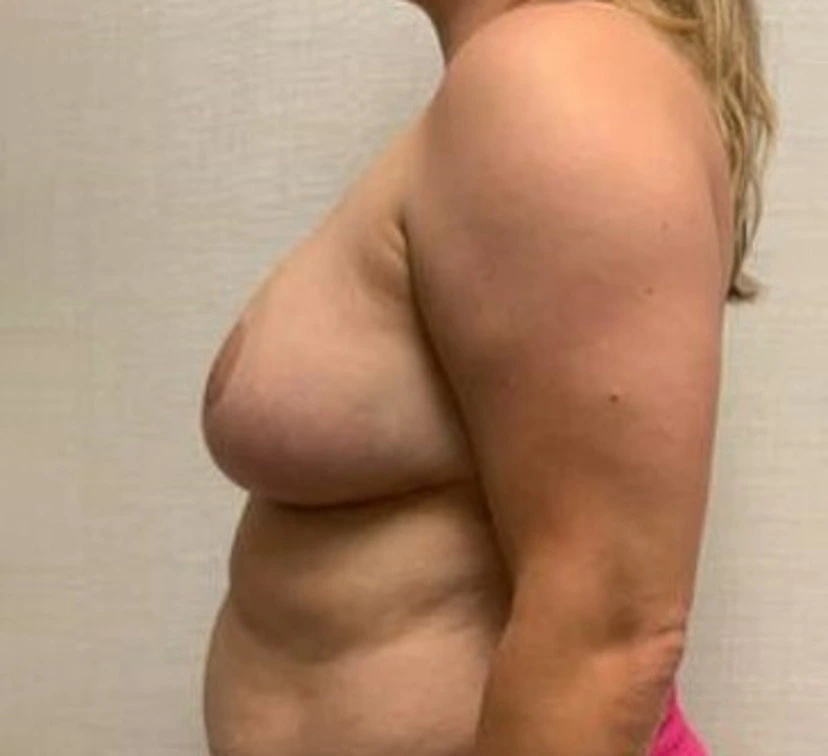 Breast-Reconstruction-Case--26525 | After Breast Reconstruction 2