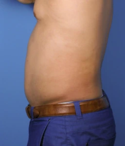 Case--389 | After Liposuction 2