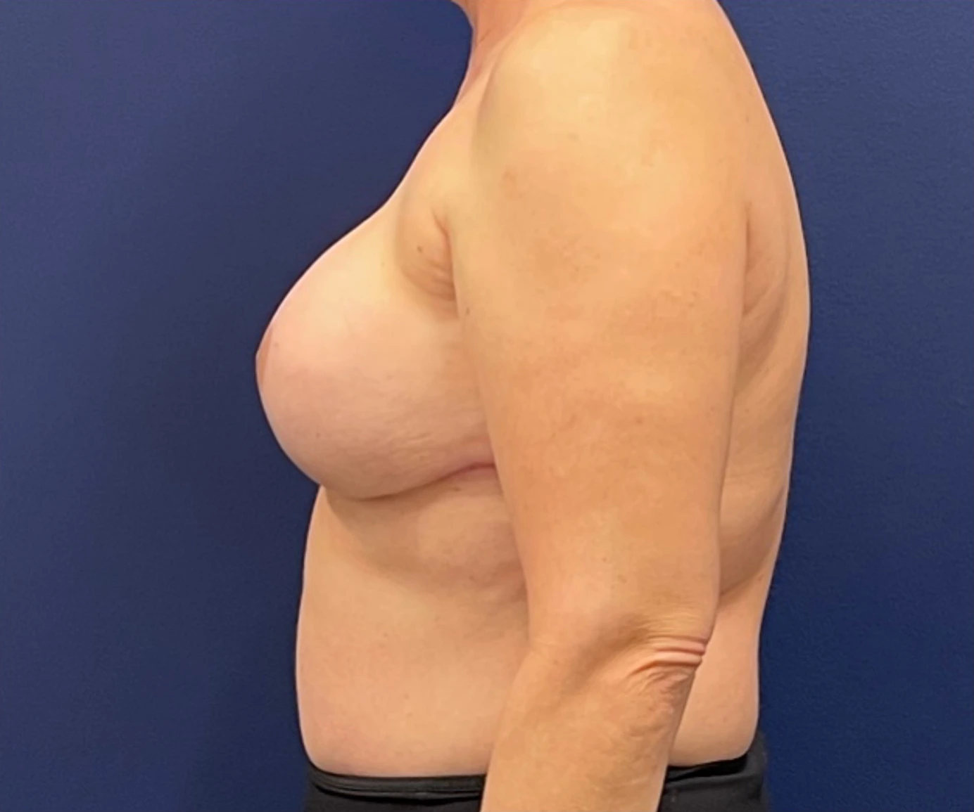 Breast-Reconstruction-Case--308 | After Breast Reconstruction 2