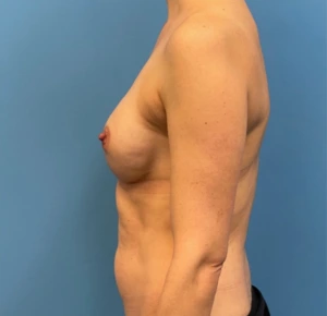 Breast-Reconstruction-Case--25209 | After Dr. Samir Rao 2