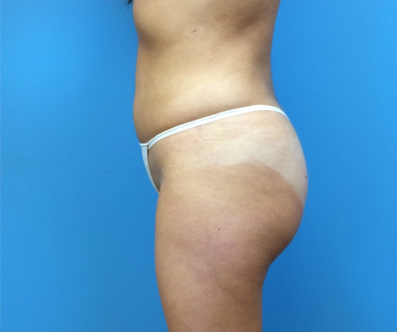Brazilian-Butt-Lift-Case--265 | After Brazilian Butt Lift 2