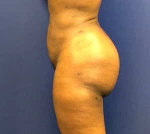 Brazilian-Butt-Lift-Case--267 | After Brazilian Butt Lift 2