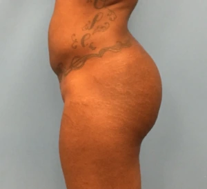 Brazilian-Butt-Lift-Case--271 | After Brazilian Butt Lift 2