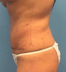 Case--65 | After Liposuction 2